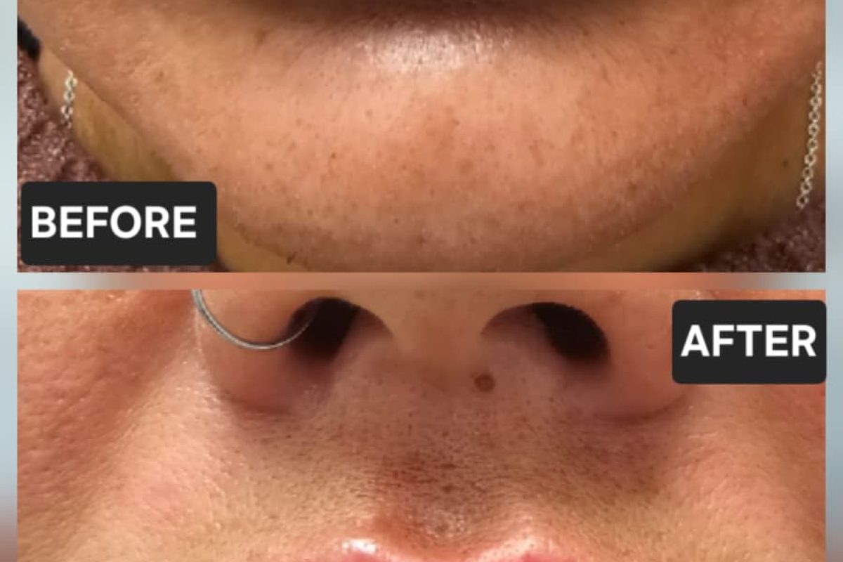 Lip Filler